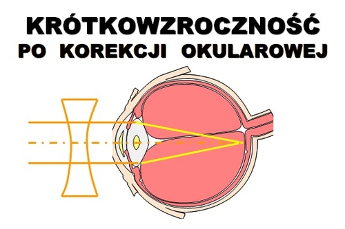 Krótkowzroczność po korekcji okularowej