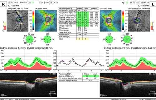 SOCT RNFL i OHT prawidłjpg