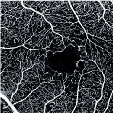 Angio OCT plamka cukrzyca