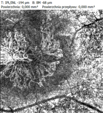 Angio SOCT błona NV pod siatkówką