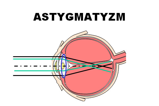 astygmatyzm