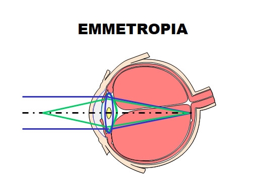 emmetropia